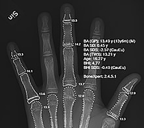 Bone Age Assessment